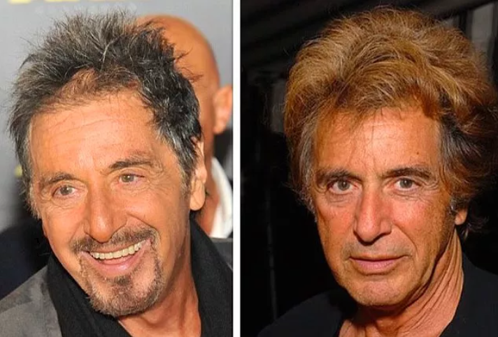 Celebrities who have had hair transplants Al Pacino