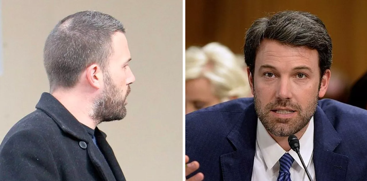 Celebrities who have had hair transplants Ben Affleck