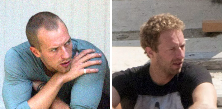 Celebrities who have had hair transplants Chris Martin