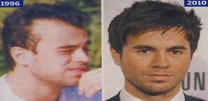 Celebrities who have had hair transplants Enrique Iglesias