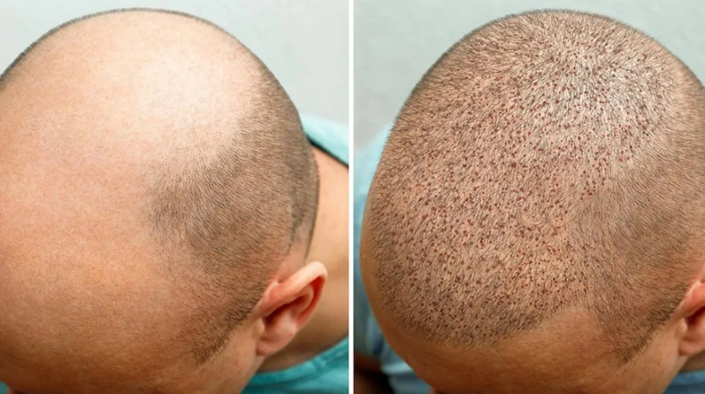 8 things you need to know before a hair transplant, stages of hair transplant for men 1