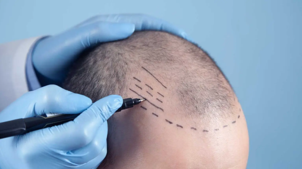 8 things you need to know before a hair transplant, stages of hair transplant for men 2