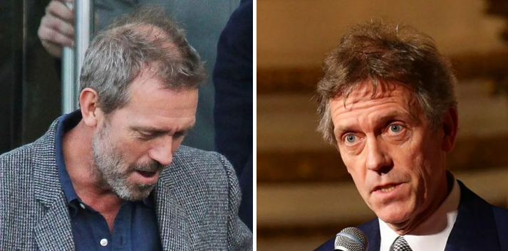 Celebrities who have had hair transplants Hugh Laurie