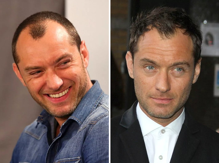 Celebrities who have had hair transplants Jude Law