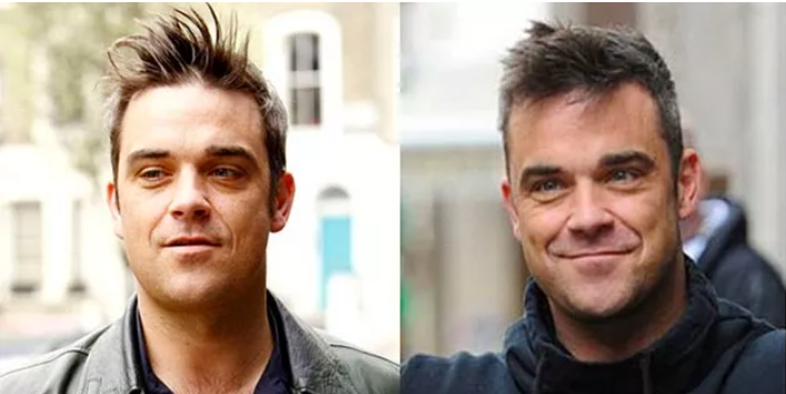 Celebrities who have had hair transplants Robbie Williams