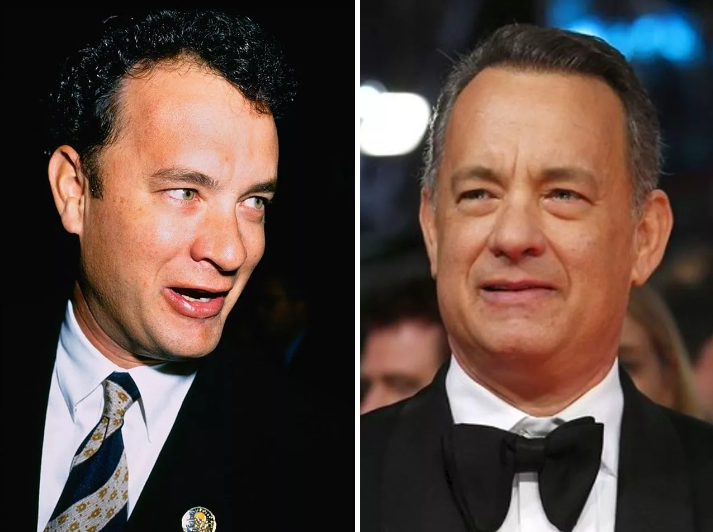 Celebrities who have had hair transplants Tom Hanks